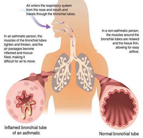 Bronchial Tubes